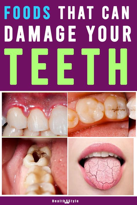 Not all foods are good for your teeth. Some can cause serious damage your teeth and lead to a whole lot of oral health concerns.  Dry fruits are indeed healthy but they are sticky too. And when they get stuck between the teeth and crevices which may cause tooth decay ans cavities  Read to know more foods which can damage teeth.  #foods #teeth #foodsforteeth #badfoodsforteeth #dentalhealth #oralhealth #foodstoavoid #toothdecay #cavites Tooth Healthy Foods, Foods For Healthy Teeth And Gums, Teeth And Gum Health, Foods For Healthy Teeth, How To Make Your Teeth Stronger, Food For Teeth Health, How To Make Teeth Stronger, How To Strengthen Teeth, Food For Healthy Teeth