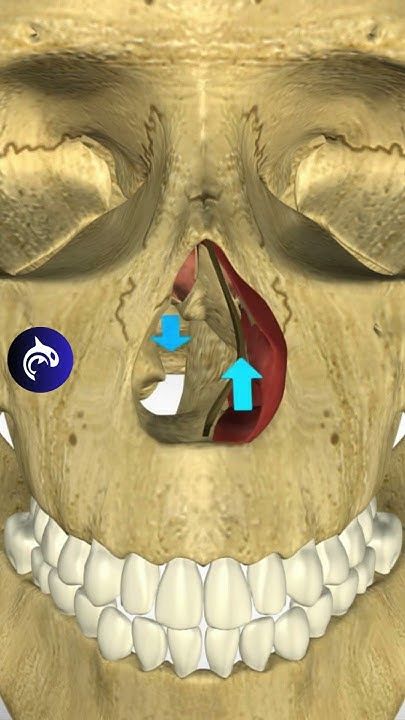 Deviated Septum   A deviated septum occurs when the nasal septum is off-center, affecting nearly 80% of people to some degree. Surgery (septoplasty) can correct severe cases, improving breathing and reducing snoring.   Visualize and understand the Deviated Septum in our 3D animated video below:  YouTube: Deviated Nasal Septum Surgery, Deviated Nasal Septum, Nasal Septum, Sleep Health, What Happens When You, 3d Animation, Animated Gif, Surgery, Instagram