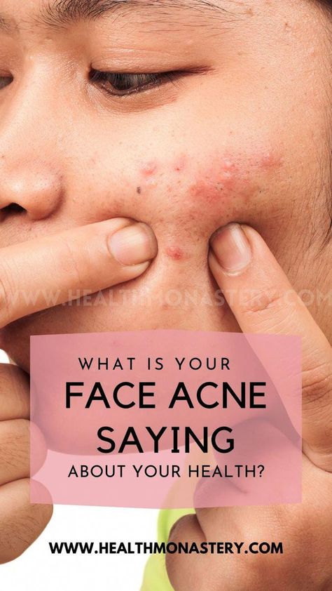 Have you ever wondered, if your pimples could talk, they could tell you what's happening inside your body? Well, acne face mapping is one such technique that does a similar job. It can help you find out the cause of the breakouts. Face mapping is an ancient Ayurvedic and Chinese technique that links specific acne… Cheek Pimples Cause, Types Of Acne On Face, Acne Cheeks How To Get Rid, Jawline Acne Causes, Types Of Pimples On Face, Jaw Line Acne, Pimple Face Mapping, Cheek Acne Cause, Face Acne Remedies