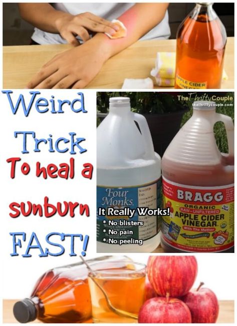 How to Heal A Sunburn (No blisters, No Pain and No peeling) and Turn Into A Tan Naturally and Frugally with Vinegar - It Really Works - The Thrifty Couple Sunburn Face Remedy, Sunburn Remedies Apple Cider Vinegar, Severe Sunburn Relief, Best Sunburn Remedy, Sunburn Relief Instant Diy, Vinegar For Sunburn Relief, How To Heal Sunburn Fast, Sun Burn Remedy Overnight, Home Remedy For Sunburn