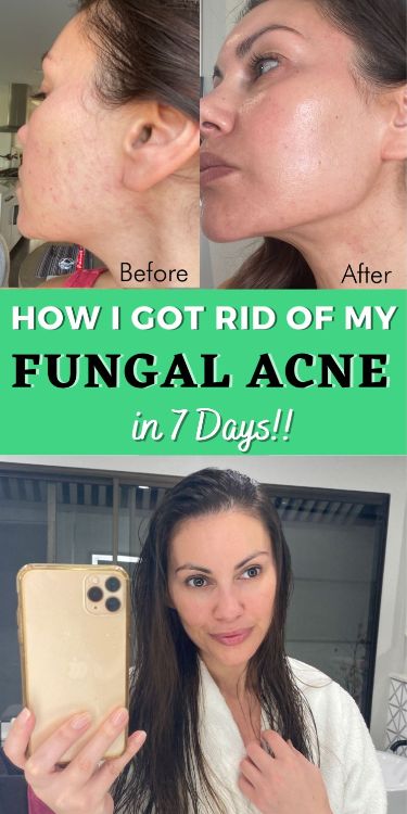 Fungal Acne: How I Got Rid of My Malassezia Folliculitis in 7 Days! Get Rid Of Fungal Acne, Glowing Skin Secrets, Face Mapping Acne, Sensitive Acne Prone Skin, Fungal Acne, Acne Overnight, Acne Treatments, Natural Face Skin Care, Hormonal Balance