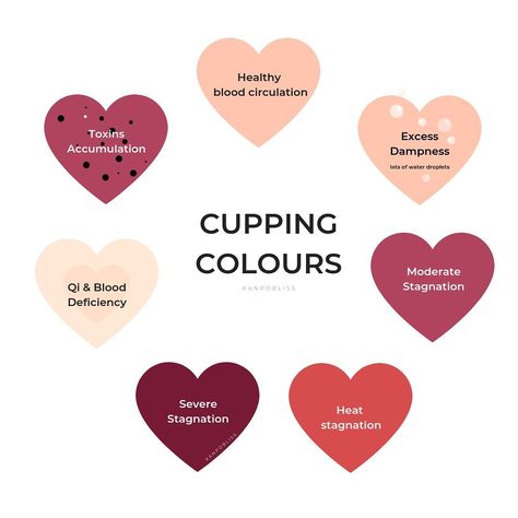 Cupping Points, Benefits Of Cupping, Massage Marketing, Fire Cupping, Massage Quotes, Massage Therapy Business, Cupping Massage, Sports Therapy, Therapy Quotes