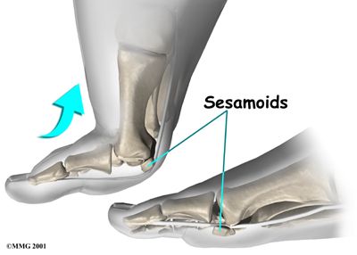 Foot Sesamoiditis Anatomy, Sesamoid Bones Movement -- mine are coming out October 5th :( Sesamoid Bone, Hip Problems, Types Of Surgery, October 5th, Psoas Muscle, Body Joints, Orthopedic Surgery, Shin Splints, Patient Education