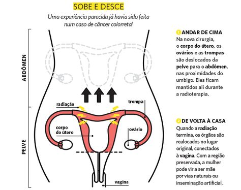 A cirurgia contra o câncer de colo de útero que não afeta a fertilidade Disease, Health