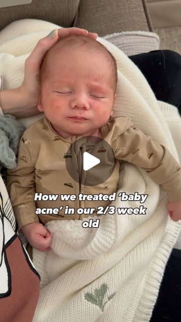 Baby Acne Remedy, Newborn Acne, Baby Acne, Lower Back Pain Exercises, Motherhood Journey, Back Pain Exercises, Baby Tips, Skin Disorders, Baby Milk