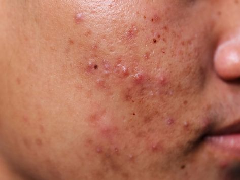 These powerful close-up photos of acne will change the way you think about your skin Acne Photos, Back Acne Remedies, Blind Pimple, Pimples Under The Skin, Prevent Pimples, Forehead Acne, Natural Acne Remedies, How To Remove Pimples, How To Get Rid Of Pimples