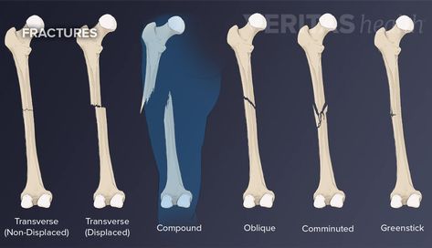 Heal Broken Bones, Open Fracture, Types Of Fractures, Hairline Fracture, Types Of Bones, Teaching Math Strategies, Bone Fracture, Baby Life Hacks, Broken Leg