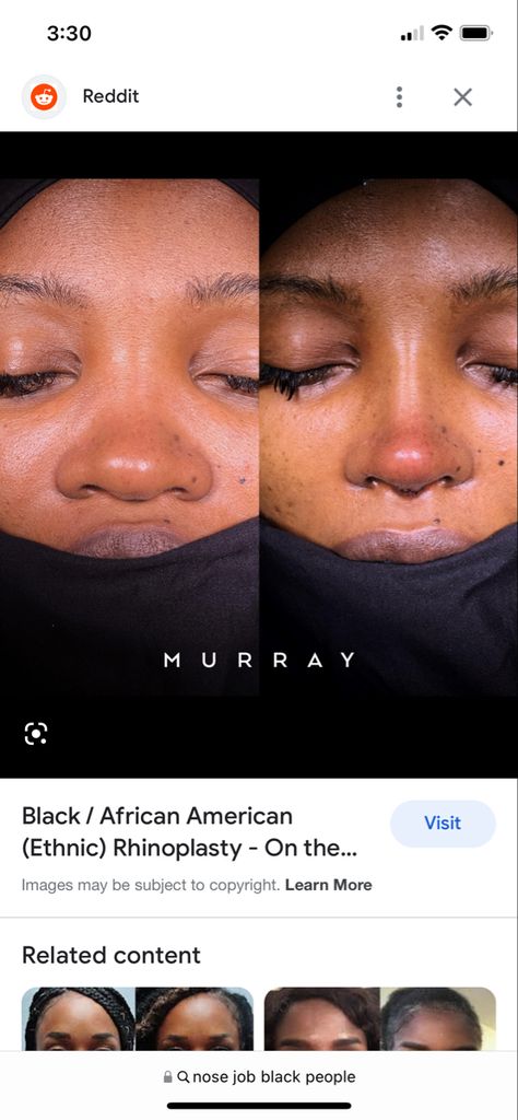 Rhinoplasty Black Women, Pretty Lip Fillers, Flat Button Nose, Nose Jobs Black Women, Rhinoplasty Before And After Black Women, Black Rhinoplasty, Black Nose Job, Wide Button Nose, Flat Wide Nose