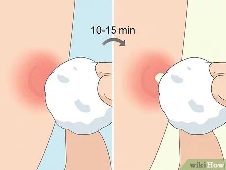 How to Instantly Get Rid of a Pimple (Cotton Ball Popping Method) Pimples On Lip Line, Ingrown Pimple, Cheek Pimples, Deep Pimple, Lip Pimple, Dry Out Pimples, Zit Remedy, Rid Of Acne Overnight, Get Rid Of Acne Overnight