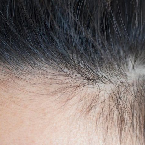 Broken hair along your hairline can be frustrating. We asked an expert how to improve the health of our hair line and the best way to encourage regrowth. Sores On Scalp, Make Your Hair Grow Faster, Forehead Hair, Hair Grow Faster, Traction Alopecia, Best Hair Mask, Breaking Hair, Homemade Facials, Hair Line