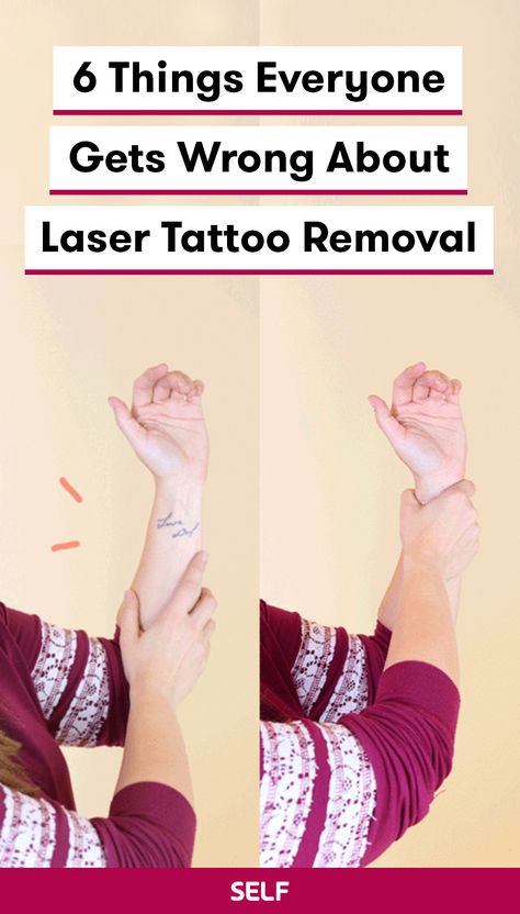 Though lasers are helpful, efficient, and effective when it comes to tattoo removal, there are a bunch of misconceptions about what they can (and can’t) do. Before you willingly get that questionable song lyric etched into your forearm—or take the plunge to have something old removed—here’s what you should know about the laser process first.