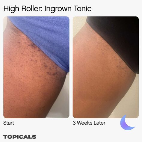 High Roller Ingrown Hair Tonic with AHA and BHA - Topicals | Sephora Topicals Ingrown Tonic, Army Bedroom, Body Perfume, Natural Hair Removal, Eyeliner Hacks, Face Skincare, Underarm Hair Removal, Black Skin Care, Ingrown Hairs