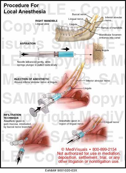 Local anesthesia in dentistry Local Anaesthesia In Dentistry, Dental Hygiene Local Anesthesia, Dental Local Anesthesia, Dental Anesthesia Injection Sites, Local Anesthesia Dental Hygiene, Local Anesthesia Dental, Dental Anesthesia, Dental Infographics, Local Anesthesia