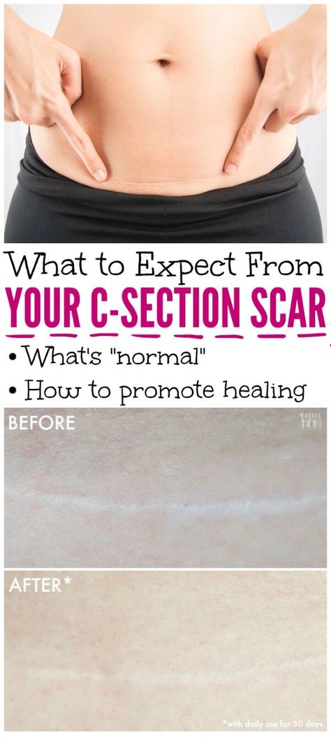 C Section Scar, C Section Scars, C Section Recovery, Scar Cream, Home Remedy For Cough, Skin Natural Remedies, Cold Sores Remedies, Natural Sleep Remedies, Natural Cold Remedies