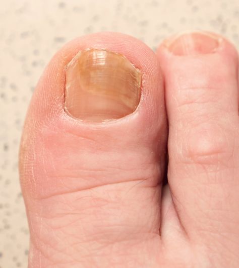 Toe Nail Growth Remedies, Natural Toenail Fungus Remedy, Brittle Toenails, Infected Toenail, Toenail Health, Toenail Fungal Infection, Nail Discoloration, Nail Falling Off, Toenail Fungus Remedies