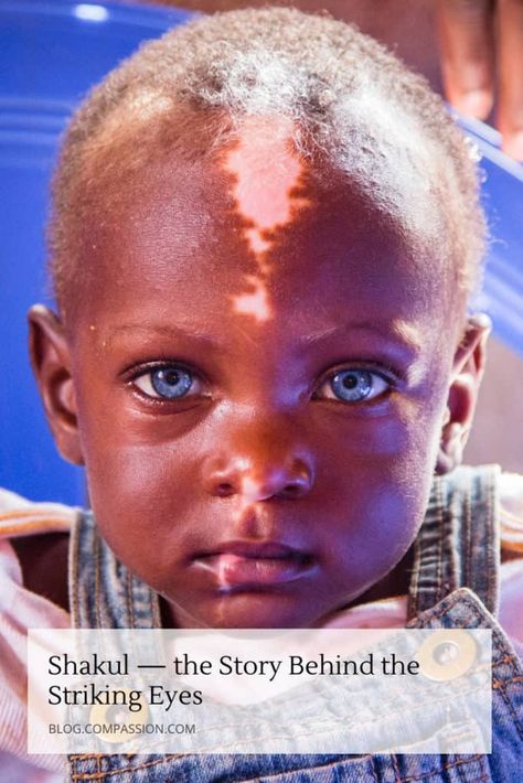 Shakul’s blue eyes are mesmerizing. But the story behind them will capture your hearts. Read this blog post to see how this little boy’s unique differences have affected his life – and how he inspires people in his Ugandan community each day. Waardenburg Syndrome, Heterochromia Eyes, People With Blue Eyes, Rh Negative, Special Needs Teacher, Pale Blue Eyes, Rare Genetic Disorders, Blue Eyed Baby, Sweet Hug