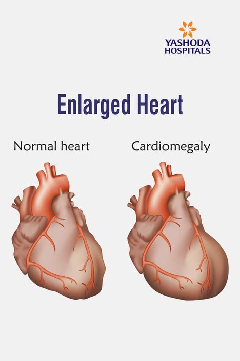 Heart Valve, Enlarged Heart, Heart Rhythm, Lung Transplant, Heart Valves, Normal Heart, Heart Muscle, Heart And Lungs, Heart Conditions