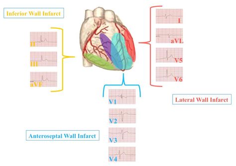 12 lead Ekg Leads, Cardiology Nursing, Medical Symptoms, Paramedic School, Study Cards, Med School Motivation, Emt Paramedic, Cardiac Nursing, Heart Anatomy