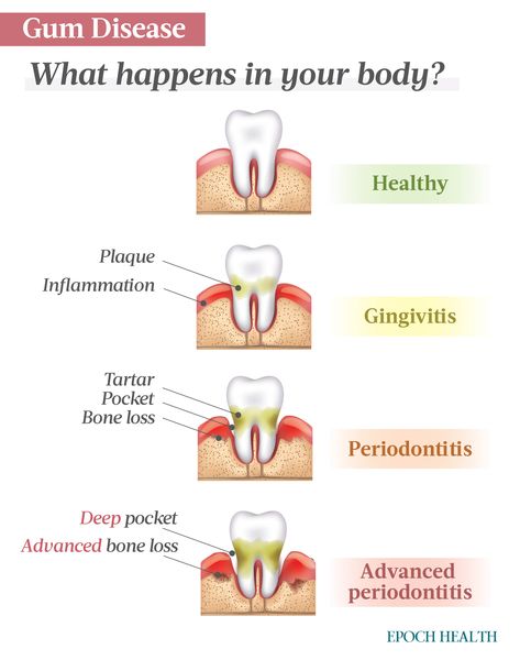 The Essential Guide to Gum Disease: Symptoms, Causes, Treatments, and Natural Approaches Teeth Diseases, Gum Surgery, Tooth Infection, Signs Of Inflammation, Gum Recession, Dental Cavities, Bone Diseases, Disease Symptoms, Bone Loss