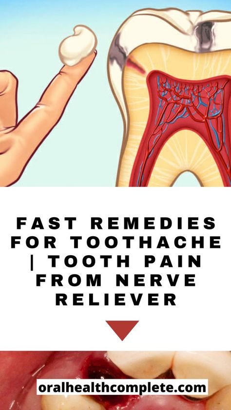 Fast Remedies For Toothache | Tooth Pain From Nerve Reliever Cavity Pain, Cavity Remedy, Toothache Relief, Nerve Pain Remedies, Tooth Pain Remedies, Tooth Pain Relief, Tooth Nerve, Tooth Ache, Tooth Ache Relief