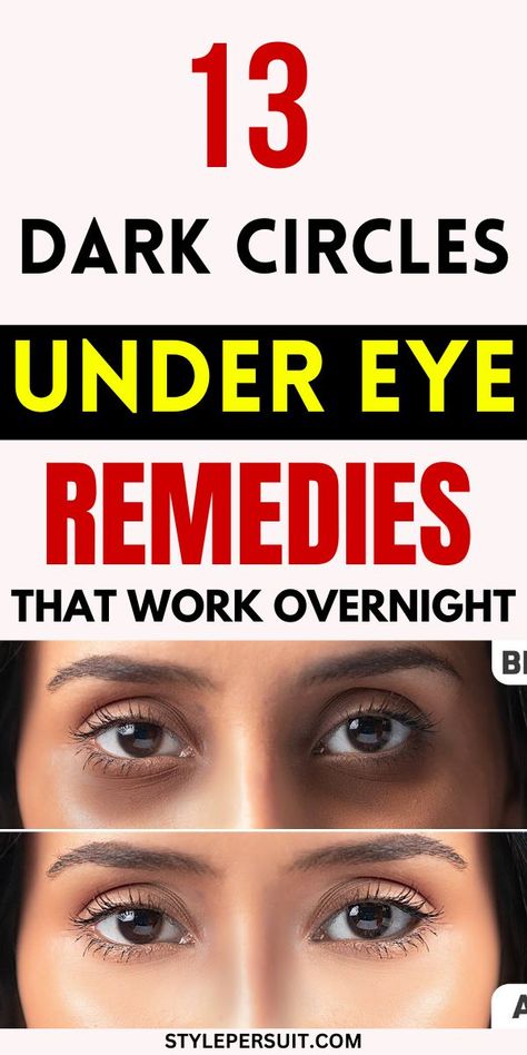 Struggling with dark circles under eye? Learn the causes, symptoms, and a range of dark circles natural remedies you can try at home to effectively treat and minimize them. Eye Circle Remedies, Dark Circle Remedies, Dark Circles Around Eyes, Dark Eye Circles, Anti Wrinkle Skin Care, Fade Dark Spots, Dark Circles Under Eyes, Dark Under Eye, Under Eyes