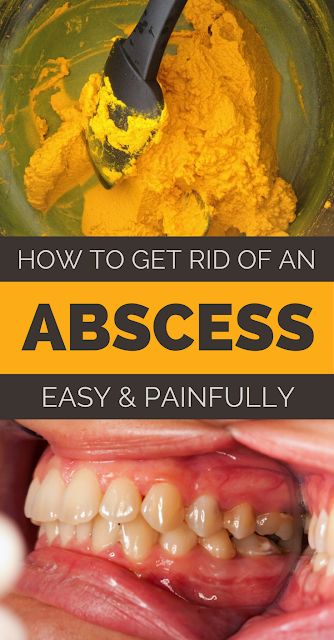 Gum Abscess, Dental Abscess, Abscess Tooth, Ayurveda Vata, Natural Medicines, Teeth Remedies, Tooth Infection, Cold Remedy, Natural Antibiotic