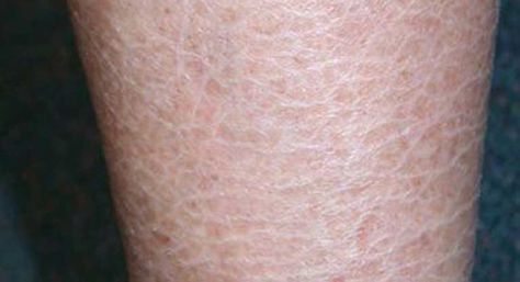 Ichthyosis Vulgaris-"fish-scale disease" occurs when your skin doesn't shed its dead skin cells Dry Skin Legs, Ichthyosis Vulgaris, Dry Scaly Skin, Dry Legs, Scale Skin, Extremely Dry Skin, Skin Care Routine For 20s, Dry Flaky Skin, Scaly Skin