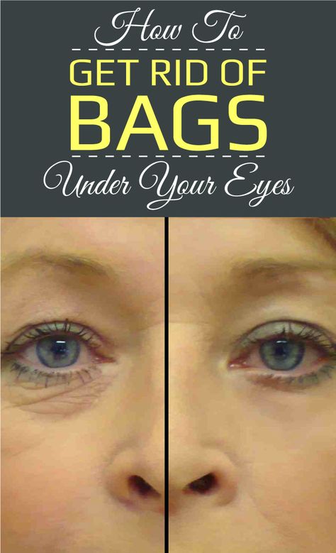 Home Remedies For Bags Under Eyes Eye Bags Remedy, Remove Under Eye Bags, Undereye Bags Remedy, Puffy Eyes Remedy, Bags Under Eyes, Remove Eye Bags, Under Eyes, Tv Screen, Under Eye Bags