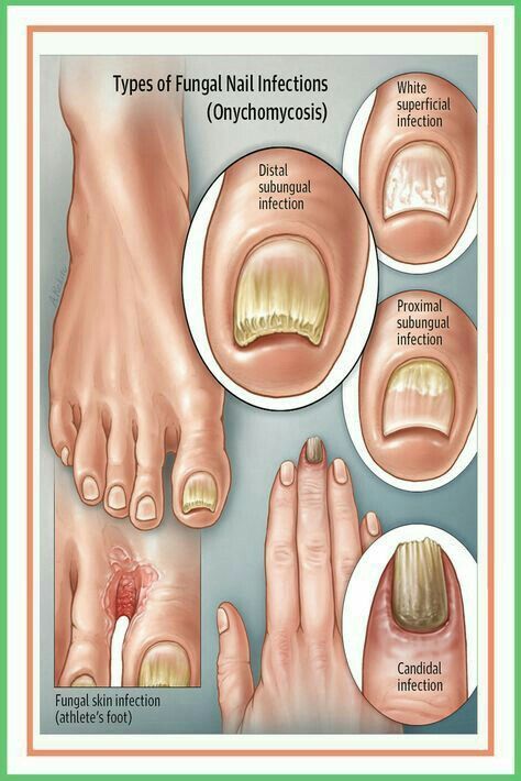 Nail Disorders, Fungal Infection Skin, Toenail Fungus Remedies, Nail Infection, Fungal Nail, Toenail Fungus, Fungal Infection, Nail Fungus, Medical Knowledge