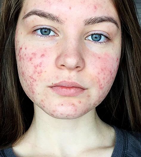 Acne Photos, Acne Pictures, Girl With Acne, Acne Positivity, Getting Rid Of Scars, Models Without Makeup, Facial Scars, Coconut Oil For Acne, Pimples On Face