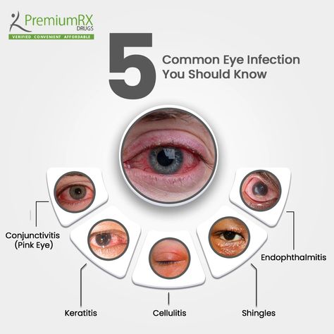 Did you know about these 5 Common Eye Infections? 👀 Stay informed and keep those eyes healthy! 1️⃣ Conjunctivitis (pink eye) 2️⃣ Keratitis 3️⃣ Cellulitis 4️⃣ Shingles 5️⃣ Endophthalmitis Knowledge is the best defense. Share to spread awareness! 👁️💡 #premiumrxdrugs #EyeHealth #StayInformed #EyeInfections #ProtectYourEyes Pink Eye Infection, Pink Eye Remedies, Optometry Humor, Eye Medicine, Eye Facts, Talking Behind Your Back, Eye Infections, Eye Logo, Healthy Morning Routine