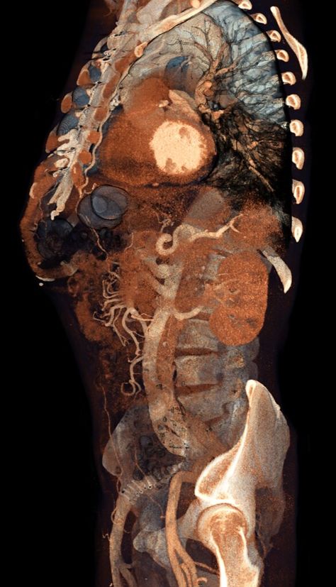 Aortic Arch, Kunstjournal Inspiration, Ct Scan, Human Anatomy Art, Drawing Faces, Medical Art, Digital Painting Tutorials, Medical Illustration, A Level Art