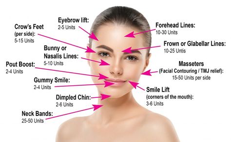 How Much Botox Do I Need? Botox Injection Sites, Tmj Relief, Botox Injection, Botox Lips, Celebrity Smiles, Eyebrow Lift, Botox Cosmetic, Facial Contouring, Face Mapping