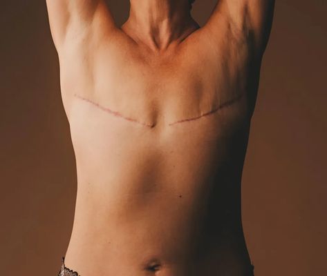 Aesthetic Flat Closure Photo Gallery - Going Flat Photos & Resources - NPOAS Flat Closure Mastectomy, Top Surgery Scars Aesthetic, Top Surgery Aesthetic, Top Surgery Party, Flat After Mastectomy, Top Surgery Scars, Flat Chested Fashion, Queer Vibes, Mastectomy Scars