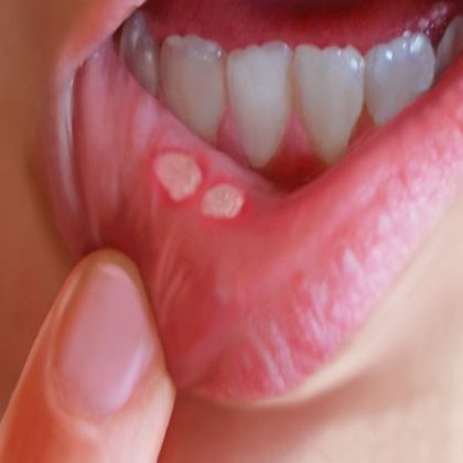 Effective Home Remedies for Canker Sores Canker Sore Remedy, Kedokteran Gigi, Canker Sore, Natural Health Remedies, Natural Home Remedies, Health And Beauty Tips, Natural Treatments, Natural Medicine, Home Health