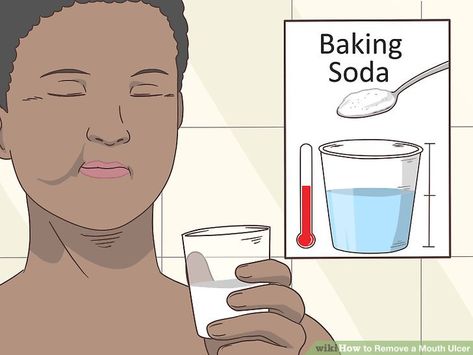 3 Ways to Remove a Mouth Ulcer - wikiHow Sore In Mouth Remedies, Ulcer On Tongue, Ulcer Remedies Mouth, Mouth Ulcer, Tongue Sores, Remedies For Dry Mouth, Mouth Rinse, Conserve Water, Canker Sore