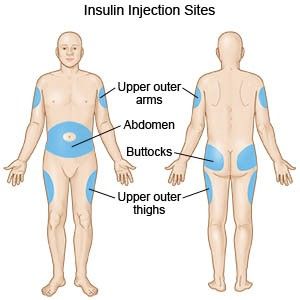 Insulin Injection Sites, Insulin Injection, Injection Sites, Nursing School Survival, Psychiatric Nursing, Fundamentals Of Nursing, Nursing School Studying, Nursing School Tips, Nursing Tips