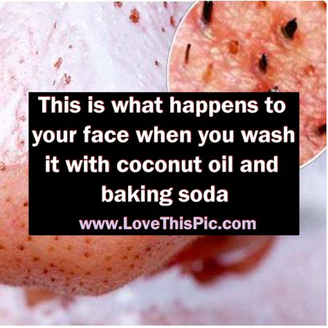 Beautiful healthy skin is something we all want. This easy to use... Coconut Oil And Baking Soda, Health Coconut Oil, Baking Soda Face, Baking Soda Benefits, Coconut Oil Skin Care, Coconut Oil Uses, Coconut Oil For Skin, Oil Uses, Skin Cleanser Products