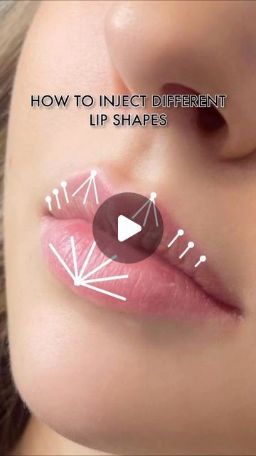 Botox For Headaches, Different Lip Shapes, 1ml Lip Filler, Juvederm Lips, Esthetician Inspiration, Heart Shaped Lips, Botox Lips, Botox Cosmetic, Botox Face