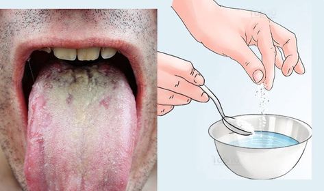 Oral thrush, also known as oropharyngeal candidiasis, is a type of yeast infection that develops inside your mouth and on your tongue. A small amount of the Candida albicans fungus is normally present in the mouth. Oral thrush occurs when your immune system cannot maintain its natural defense against this fungus and it grows out … Oregano Oil Benefits, Juice Coconut, Mouth Health, Top 10 Home Remedies, Candida Albicans, Tongue Health, Oregano Oil, Natural Antibiotics, Natural Health Remedies