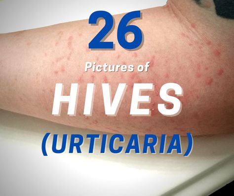 Healing Codes For Skin Allergy, Itchy Bumps On Skin, Skin Allergy Pictures, Hives On Face, Gluten Allergy Rash, How To Treat Hives, Hives Relief, Skin Rashes Pictures, Allergy Hives