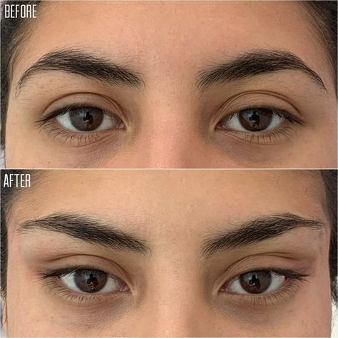 Discover Aesthetics on Instagram: “NON SURGICAL BROW LIFT with PDO threads! 👁 Follow @discover.aesthetics for more!⠀⠀⠀⠀⠀ -⠀⠀⠀⠀⠀ The #1 Destination to discover the Wide Array…” Balayage, Eye Lift Surgery, Botox Brow Lift, Lip Surgery, Pdo Threads, Face Surgery, Botox Lips, Eyebrow Lift, Cheek Fillers