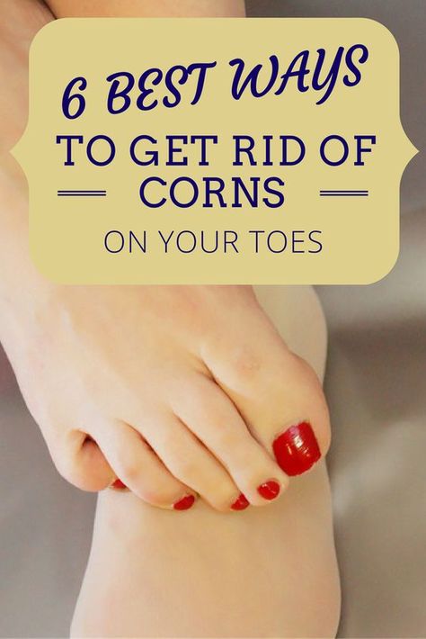 Remove Corns On Feet Remedies, Get Rid Of Corns On Feet Fast, Foot Corn Removal Remedies, How To Get Rid Of Corns On Toes, Corn Removal On Toes, Get Rid Of Corns, Corn Removal, Foot Soaks, Diy Pedicure