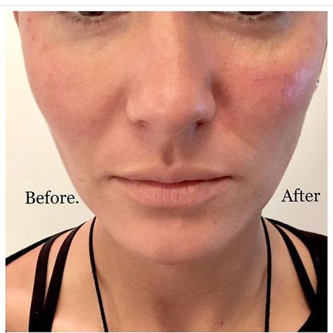 Dr. Todd on Instagram: “📷Before on the left and after Restylane Lyft injections on the right. 🎯Restylane Lyft 8 point facelift. 1️⃣Reduces darkness and flatness in…” Restylane Lyft, On Instagram, Instagram