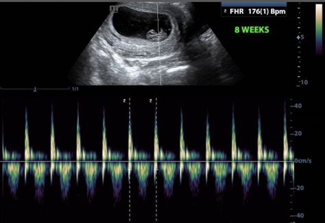 They meet when he's deep in the game wanting nothing but to breath wi… #fanfiction Fanfiction #amreading #books #wattpad Baby Heart Rate Gender Prediction, Fetal Heart Rate Gender, Heartbeat Gender Prediction, Baby Heart Rate Gender, Ultrasound Gender Prediction, Baby Heart Beat, Boy Or Girl Prediction, Ultrasound Gender, Baby Ultrasound Pictures