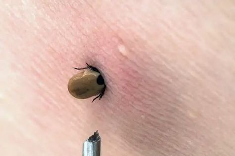 How to Identify Tick Bites | Tick Bite Pictures | IGeneX Tick Talk Tick Bites Pictures, Ticks On Humans, Types Of Ticks, Rash Causes, Tick Spray, Deer Ticks, Tick Removal, Tick Bite, Pimples Remedies