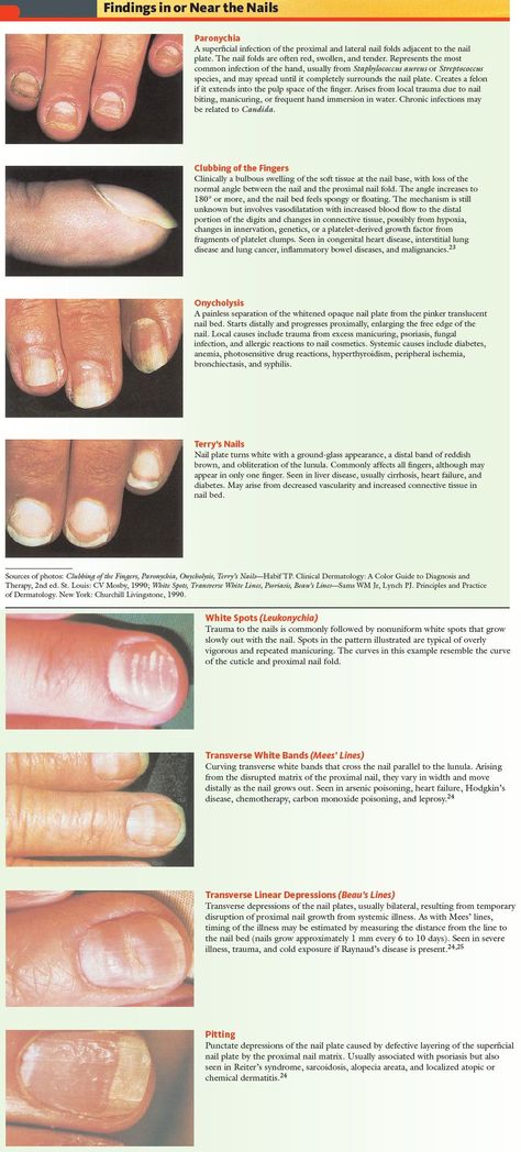 Nail Pathologies - Findings in or Near Nails  Paronychia   A superficial infection of the proximal and lateral nail folds adjacent to the nail  plate. The nail folds are often red, swollen, and tender. Represents the most  common infection of the hand, usually from Staphylococcus aureus or Streptococcus  species, and may spread until it completely surrounds the nail plate. Creates a felon  if it extends into the pulp space of the finger. Arises from local trauma due to nail  biting, manicurin Nail Disorders, Natural Antifungal, Nail Conditions, Nail Fungus Remedy, Health Signs, Tongue Health, Striped Nails, Fungal Infection, Nail Plate