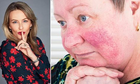 Anti-agers no one but you need know about: How can I get rid of the tiny red veins on my cheeks?  | Daily Mail Online Red Veins On Face How To Get Rid, Blood Vessels On Face, Facial Veins, Thread Veins, Get Rid Of Spiders, Red Cheeks, Red Veins, Face Home, Skin Undertones