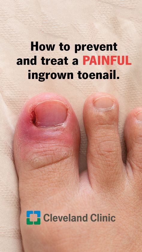 Toenail Pain, Nail Fungus Remedies, Infected Toenail, Toenail Removal, Toenail Fungal Infection, Nail Remedies, Toenail Fungus Remedies, Nail Fungus Remedy, Ingrown Toenail