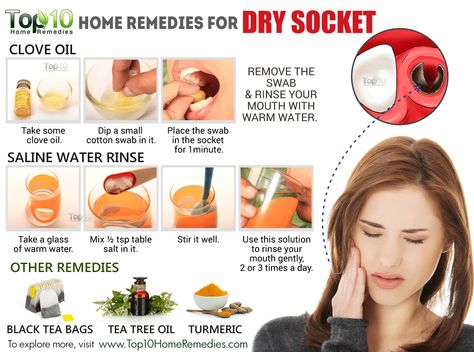 dry-socket-rev.gif (1000×744) Teeth Hacks, Teeth Extraction, Teeth Problems, Remedies For Dry Mouth, Tooth Extraction Aftercare, Wisdom Teeth Funny, Tooth Extraction Healing, Tooth Ache Relief, Wisdom Tooth Extraction